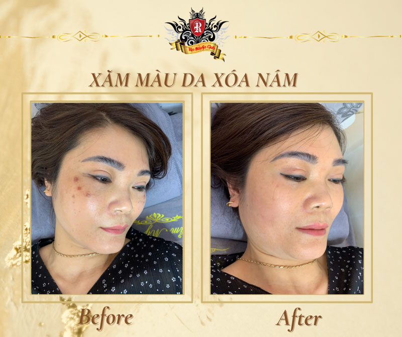 Xăm màu da che vết nám 