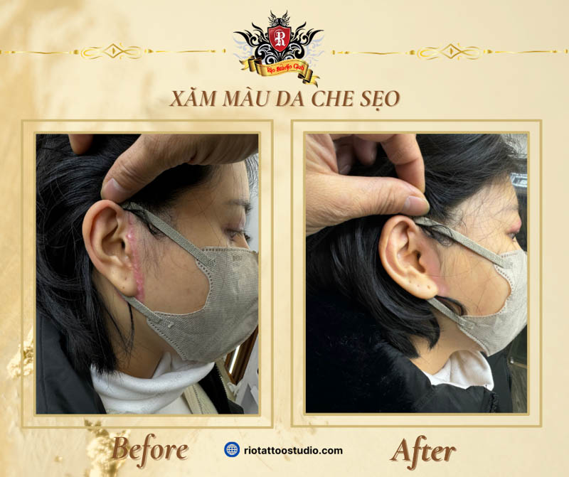 Xăm màu da che vết sẹo ở tai hiệu quả đến 90%