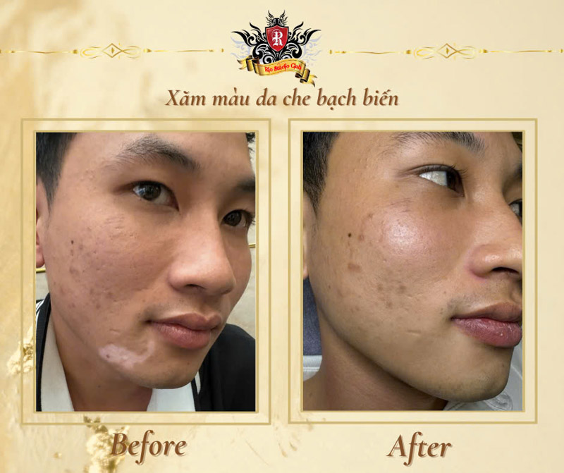 Xăm màu da che bạch biến tại Rio Tattoo Studio