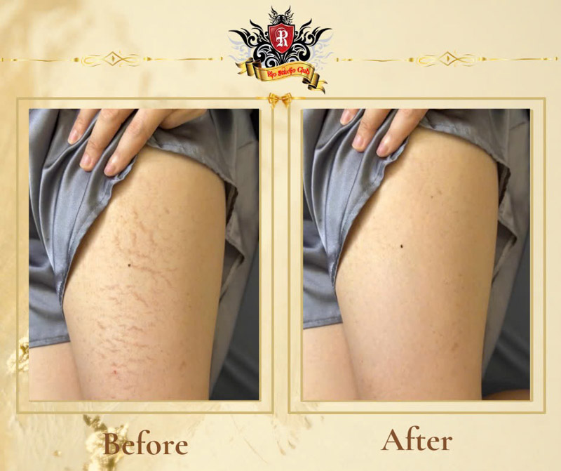 Xăm màu da che vết rạn da tại Rio Tattoo Studio