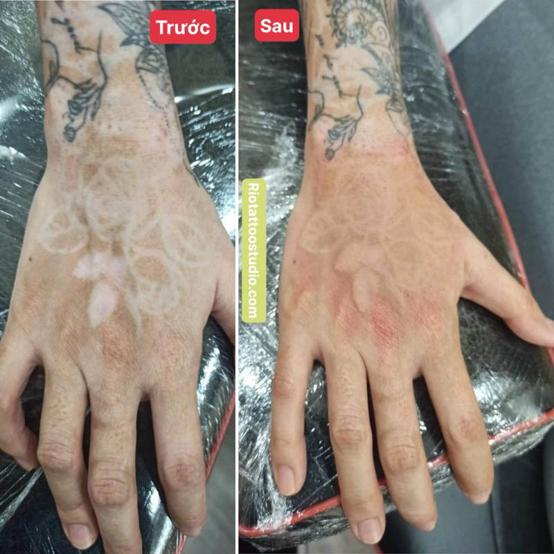 Xăm màu da ở cánh tay che hình xăm cũ