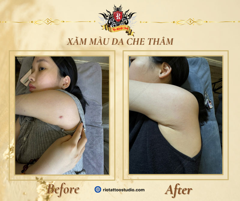 Xăm màu da tại bắp tay che đi vết thâm