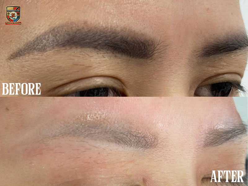 Ảnh thực tế trước và sau khi xóa xăm