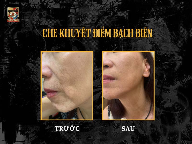 Hình ảnh so sánh trước và sau khi thực hiện kỹ thuật xăm màu da che khuyết điểm bạch biến trên vùng mặt khách hàng
