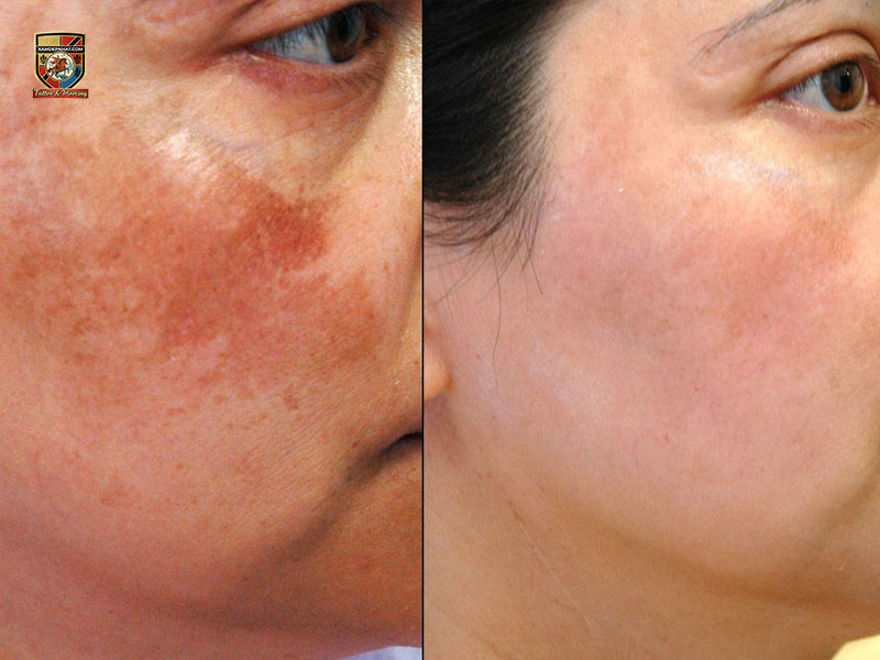 So sánh góc nghiêng gò má trước và sau khi phục hồi mờ thâm tại địa chỉ trị nám chất lượng