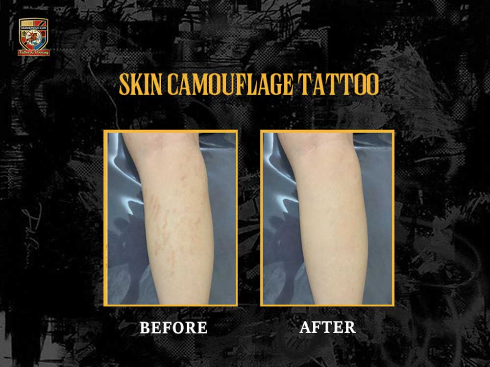 Before and after leg stretch mark concealment using skin camouflage tattoo in Hanoi