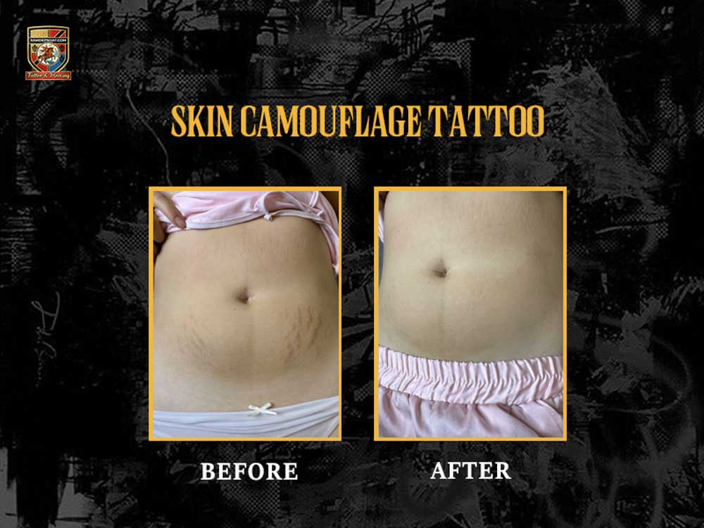 Before and after abdominal stretch mark concealment through skin camouflage tattoo in Hanoi